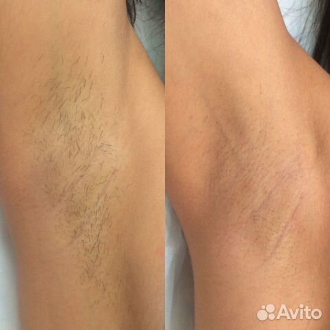 Эффективная лазерная эпиляция Семёновская Эффективная лазерная эпиляция Семёновская